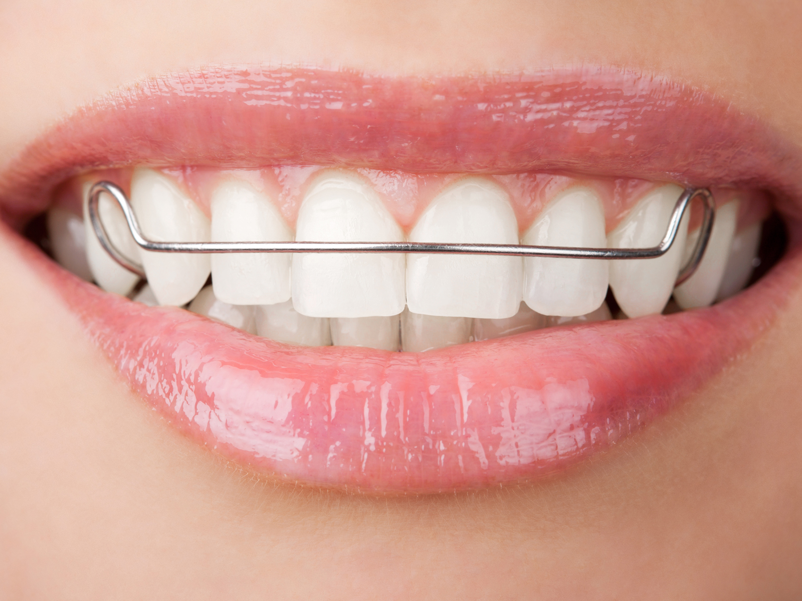 Can I wear my retainer without brushing?
