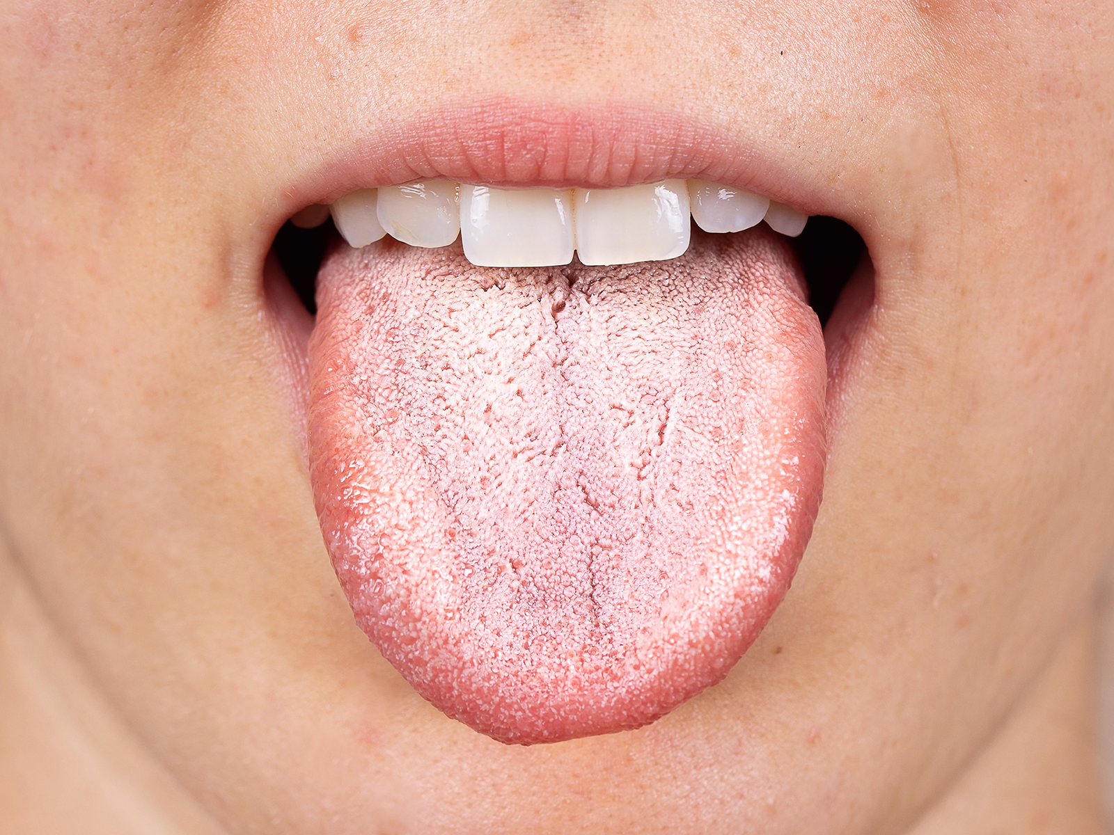 What is oral thrush and what are its causes?