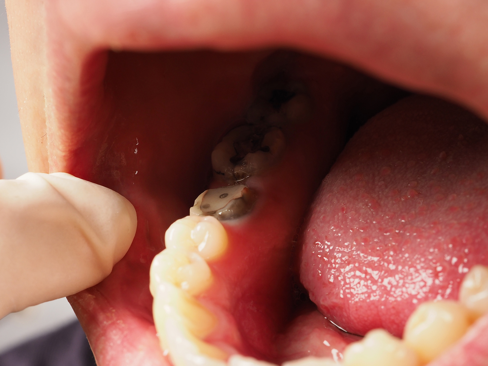 Will A Tooth Continue To Decay After A Root Canal?