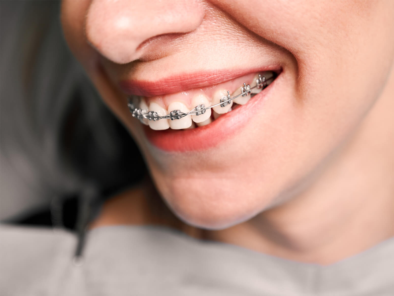 How Do Braces Work to Straighten Crooked Teeth?