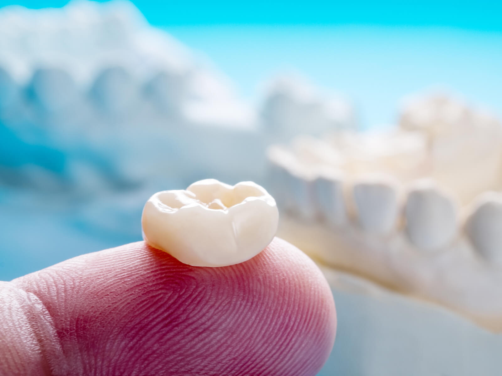 Navigating the Challenge of a Dislodged Dental Crown: Immediate Actions and Oral Hygiene Tips